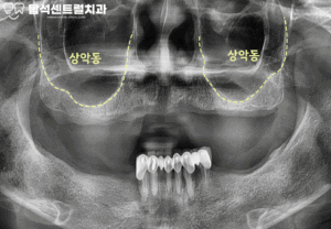 Read more about the article 임플란트 식립을 위한 상악동 거상술 시 상악동이 천공되었다면?