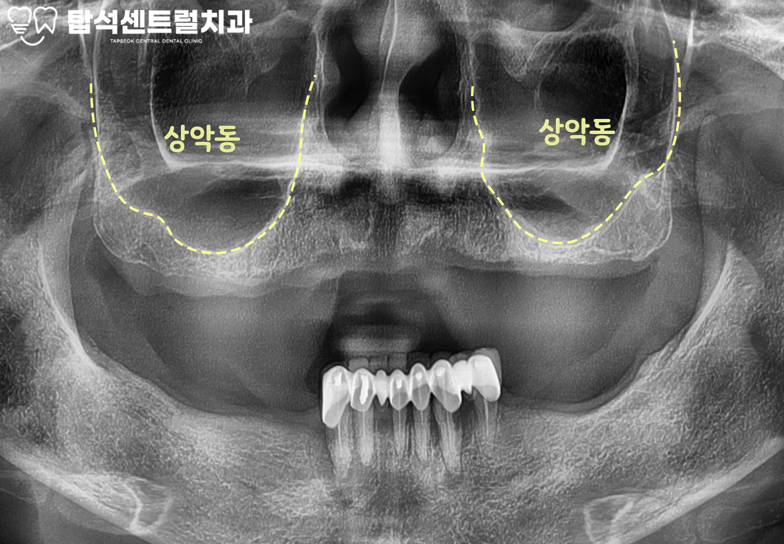 You are currently viewing 임플란트 식립을 위한 상악동 거상술 시 상악동이 천공되었다면?