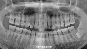 Read more about the article 다수의 치아 충치, 시린 이 탑석센트럴치과 신경치료 후 크라운, 레진, 인레이 수복