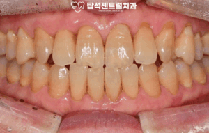 Read more about the article 민락동 치과 와 알아보는 치아 미백 원리 & 장점 & 과정 & 고려 사항