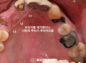 Read more about the article 탑석역 치과 치료에 대한 두려움이 있다면? 수면치료(의식하 진정요법)로 편안하게 임플란트 식립