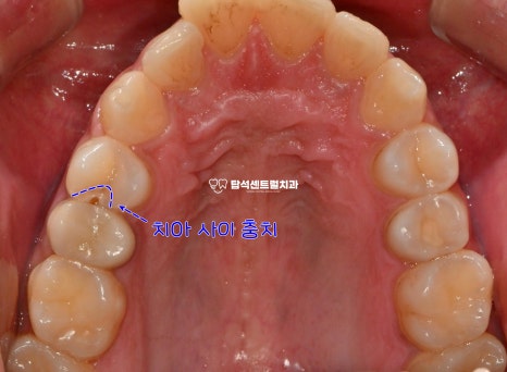 You are currently viewing 송산역 치과 누워있는 사랑니 발치 VS 치아 사이 충치 확인 후 하이브리드 인레이 수복 과정