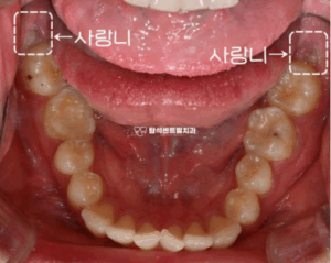 Read more about the article 민락동 치과 매복 사랑니 발치, 잇몸 염증 및 부기의 원인?