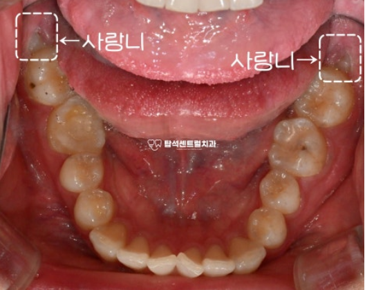 You are currently viewing 민락동 치과 매복 사랑니 발치, 잇몸 염증 및 부기의 원인?