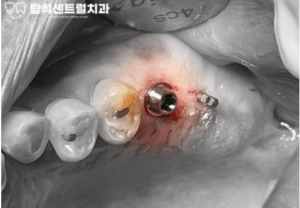 Read more about the article 송산동 치과 , 시멘트가 필요없는 하이니스 베이스 임플란트 식립 과정