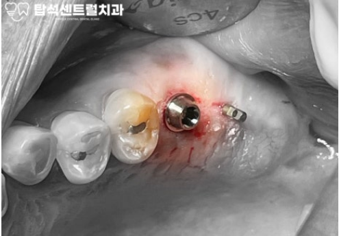 You are currently viewing 송산동 치과 , 시멘트가 필요없는 하이니스 베이스 임플란트 식립 과정