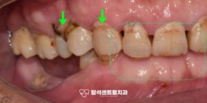 Read more about the article 충치, 치주염, 다수의 치아 결손 탑석역 치과 임플란트 뼈이식 [나이에 맞는 구강건강 관리 방법은?]