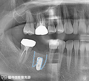 Read more about the article 치아 신경치료 후 통증, 의정부 용현동 치과 발치 후 임플란트 수술 과정