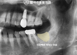 Read more about the article 뼈의 흡수를 막는 발치와 보존술: 심한 치주염 치아 발치 & 치주소파술 후 골이식술 진행, 의정부 민락동 치과