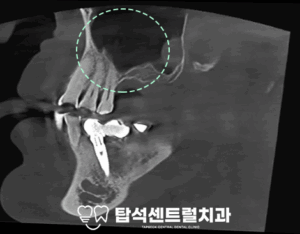 Read more about the article 임플란트 식립 시 뼈가 부족하다면? 치조정 접근법 VS 측방 접근법, 송산동 치과 에서 알려드립니다.