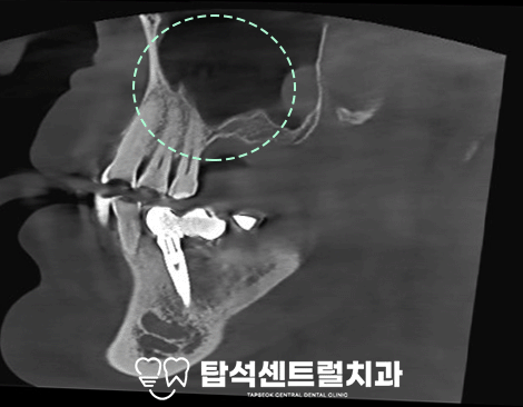 You are currently viewing 임플란트 식립 시 뼈가 부족하다면? 치조정 접근법 VS 측방 접근법, 송산동 치과 에서 알려드립니다.