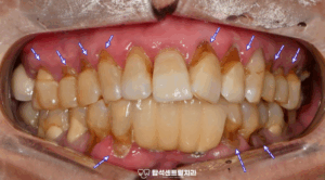 Read more about the article 송산동 치과 치경부마모증 레진 과 GI의 차이점은? 치료 과정