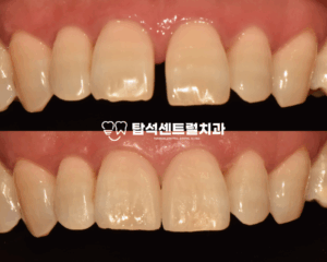 Read more about the article 벌어진 앞니 치아 교정 없이 해결할 수 있는 방법은? 의정부 용현동 치과 무삭제 라미네이트 케이스