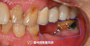 Read more about the article 발치 후 어금니 임플란트 식립 수술 과정 의정부 민락동 치과