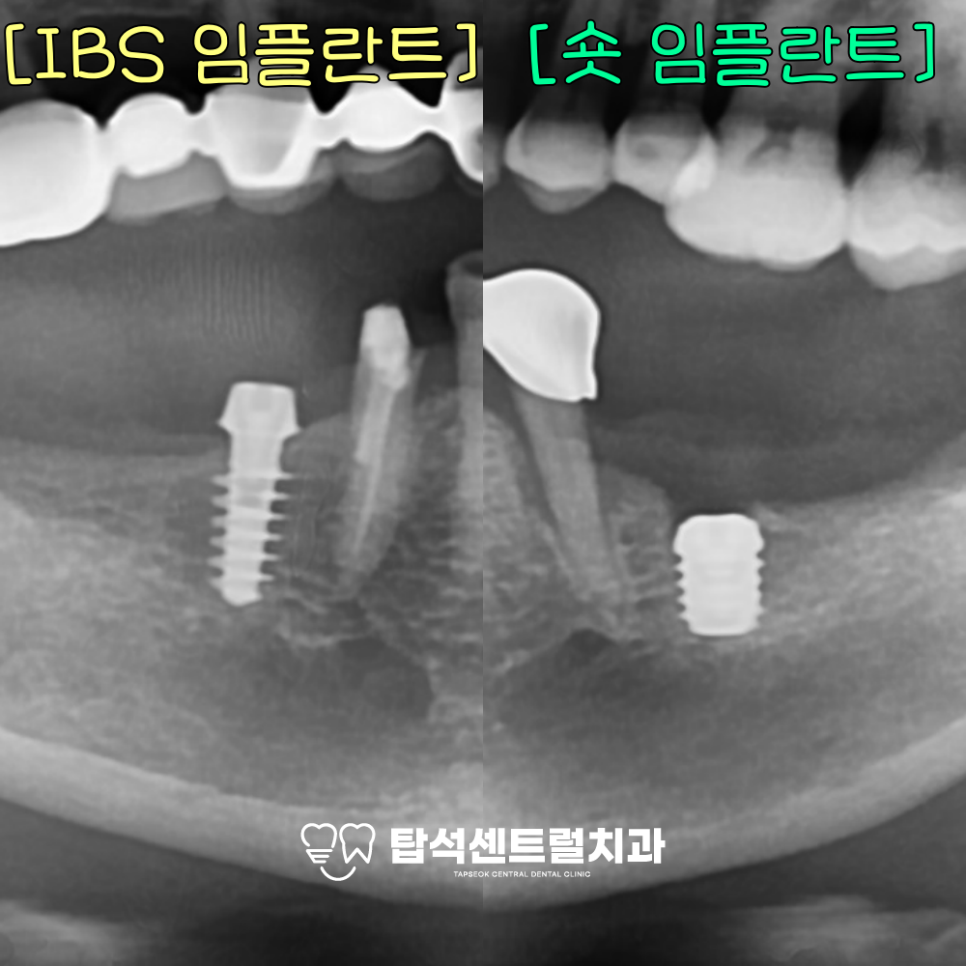 You are currently viewing 의정부 민락동 치과 아래 어금니 잇몸뼈 내려앉음, 짧은 임플란트 와 IBS 가이드 핀을 이용한 무절개 수술 과정