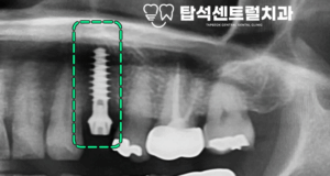 Read more about the article 의정부 용현동 치과 어금니 발치 후 IBS 임플란트 식립, flapless(무절개) 수술