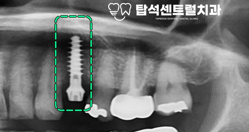 You are currently viewing 의정부 용현동 치과 어금니 발치 후 IBS 임플란트 식립, flapless(무절개) 수술
