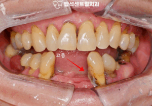 Read more about the article 충치 & 치주염으로 흔들리는 치아, 의정부 용현동 치과 수면치료(의식하 진정법)를 이용한 임플란트 식립