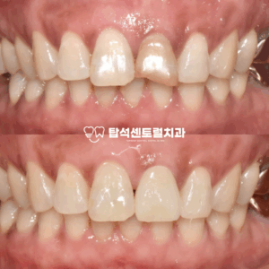 Read more about the article 넘어짐 사고! 치아 외상 앞니 변색 파절 송산동 치과 의 진료 순서와 신경치료 후 크라운
