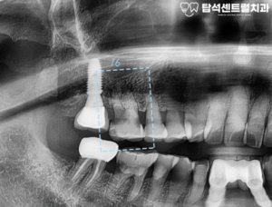 Read more about the article 송산역 치과 , 치아 뿌리 충치로 보존치료 시 예후가 불량할 때? 발치 후 즉시 임플란트 식립