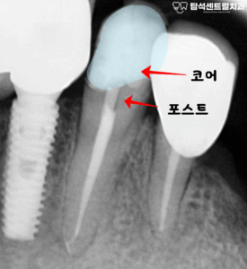 Read more about the article 의정부 용현동 치과 , 소홀한 구강 위생 관리로 남아있는 치아 양이 별로 없을 때 신경치료 하는 방법 (포스트 앤 코어)