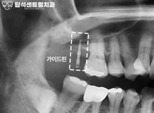 Read more about the article 고산동 치과 , 가이드핀을 이용해 정확한 계획 수립 후 최소침습 IBS 임플란트 식립