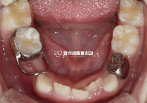 Read more about the article 소아 충치, 잇몸 고름 주머니, 조기 유치발치, 의정부 교정치과 밴드 앤 루프(Band & Loop) 공간 유지 과정