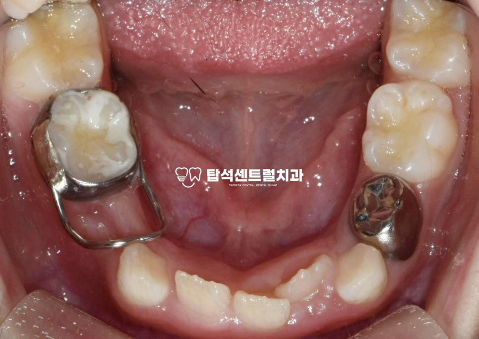 You are currently viewing 소아 충치, 잇몸 고름 주머니, 조기 유치발치, 의정부 교정치과 밴드 앤 루프(Band & Loop) 공간 유지 과정