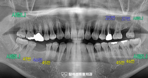 Read more about the article 의정부 민락동 치과 상악동 거상술 후 임플란트 수술 과정 치조정 접근법(크레스탈)