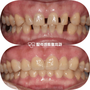Read more about the article 심한 앞니 사이 벌어짐 치료 의정부 용현동 치과 지르코니아 크라운 수복