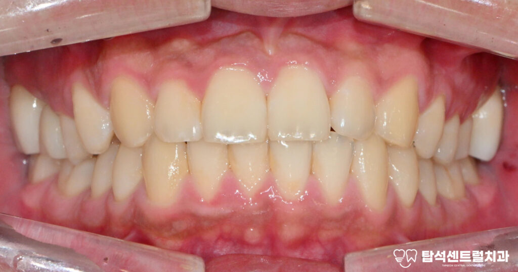 송산 치과 충치로 인한 신경 치료 & 임플란트 수술 case_사랑니 발치 진행한 복합 치료 소개
