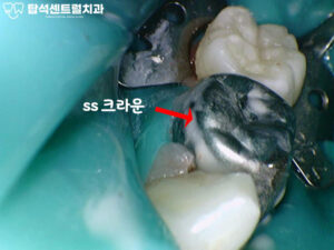 Read more about the article 용현동 치과 : 소아 다수 유구치에서 발견된 충치, 신경치료 및 ss크라운 & 레진 수복 진행