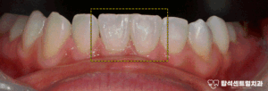 Read more about the article 민락동 치과 치아 사이 벌어짐 원인 분석하고 무삭제 라미네이트 치료 하는 과정 소개