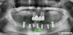 Read more about the article 의정부 치과 흔들리는 치아 통증 부위, 상악동 거상술 부작용 줄여 치료 진행 위한 방법