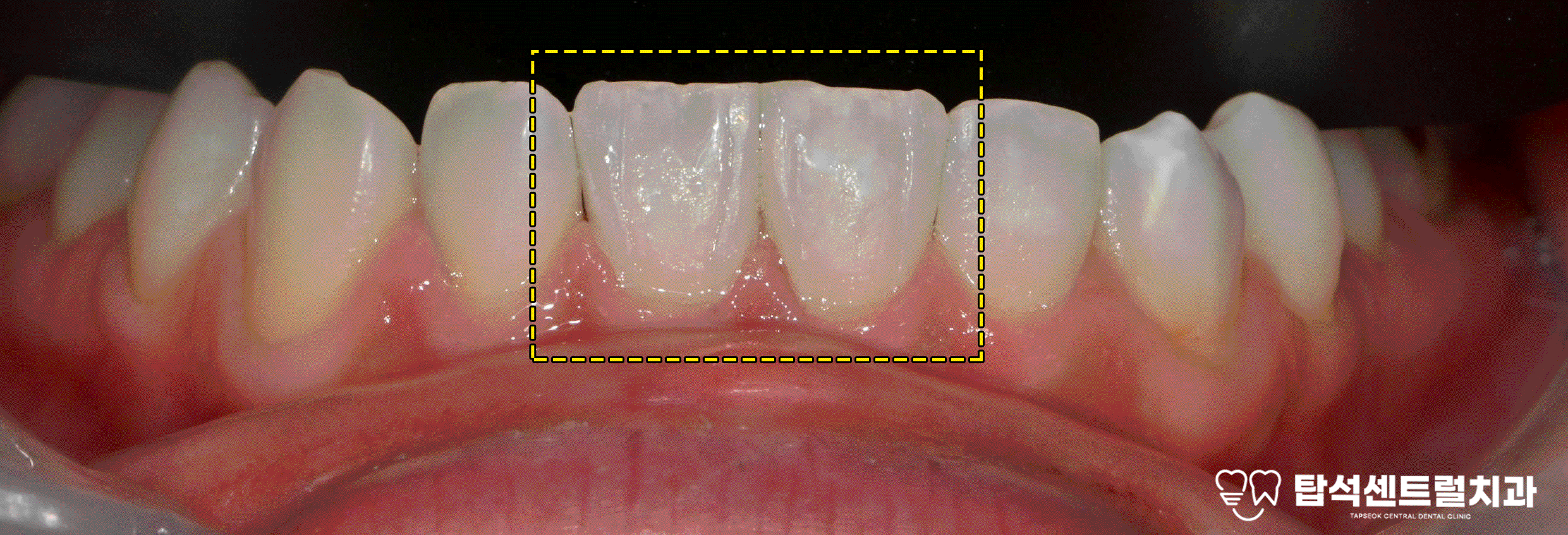 You are currently viewing 민락동 치과 치아 사이 벌어짐 원인 분석하고 무삭제 라미네이트 치료 하는 과정 소개