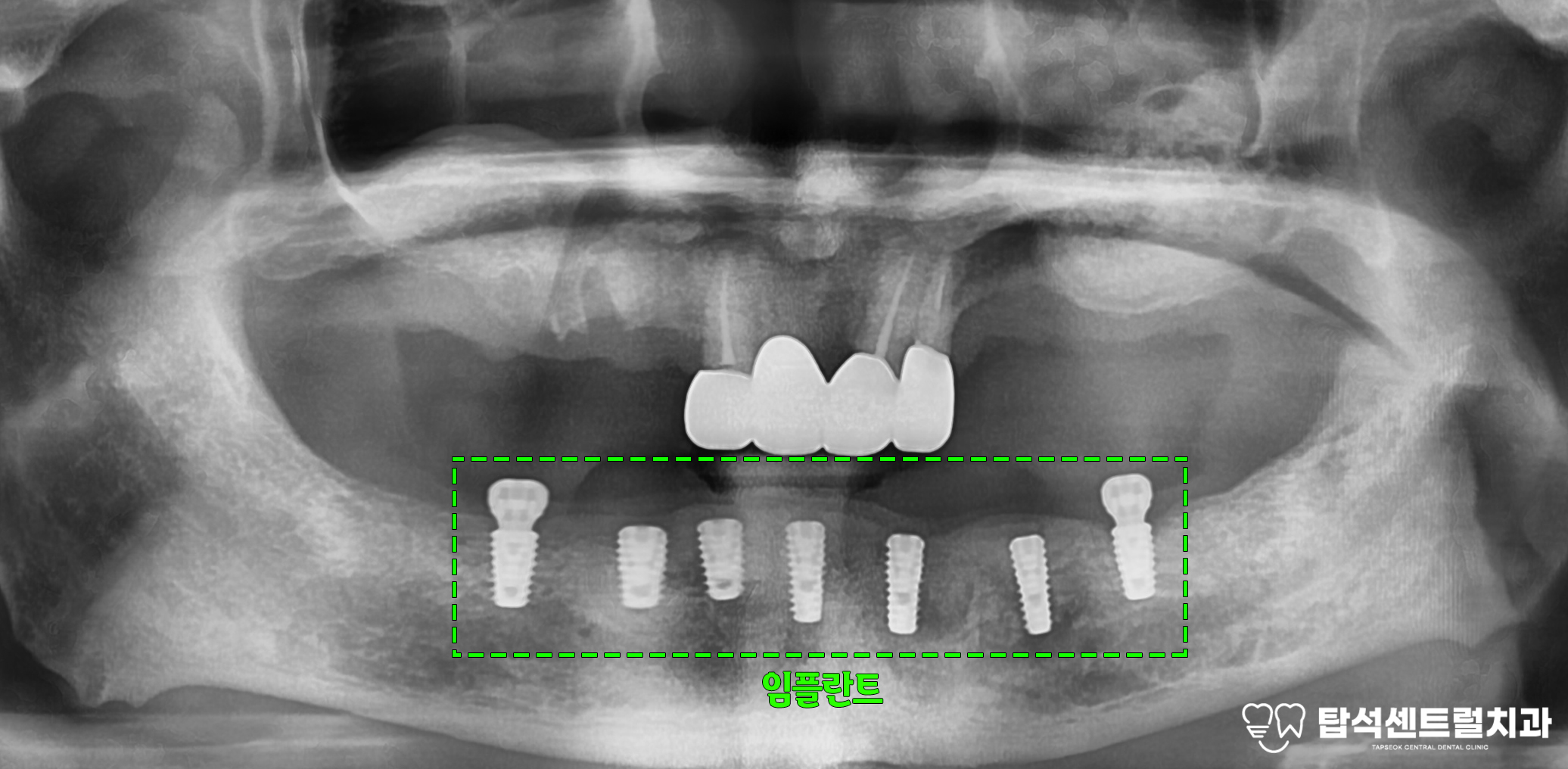 You are currently viewing 의정부 치과 흔들리는 치아 통증 부위, 상악동 거상술 부작용 줄여 치료 진행 위한 방법