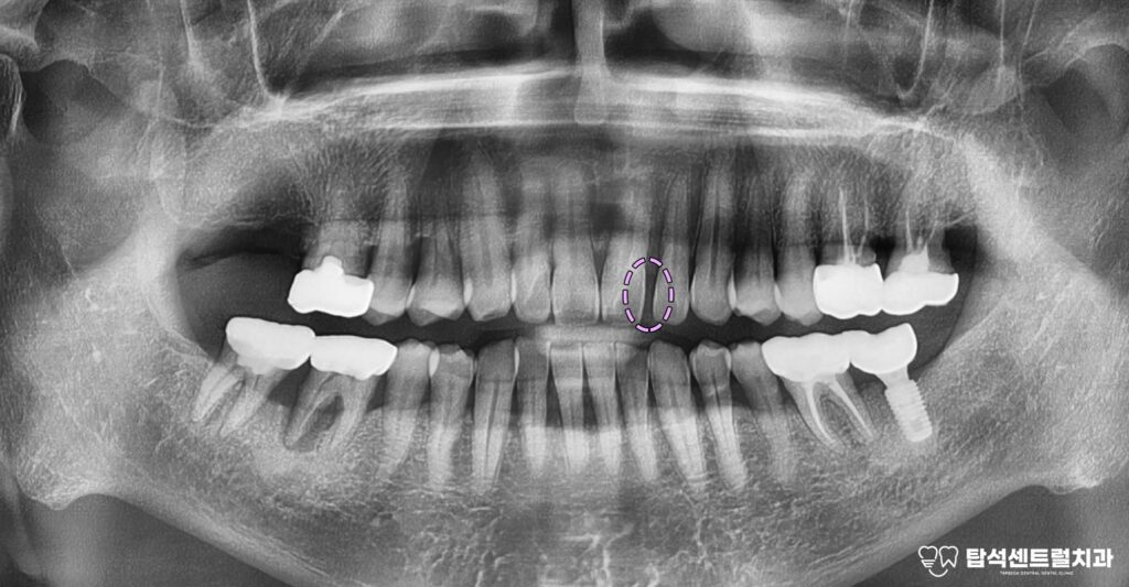 앞니 벌어짐 앞니 레진