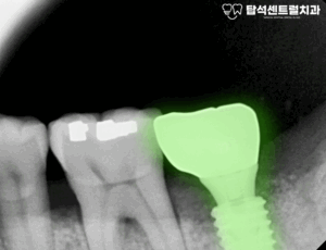 Read more about the article 고산동 치과 에서 임플란트 식립으로 상악동 거상술 시행 후 어금니 통증 잠재울 수 있을까?