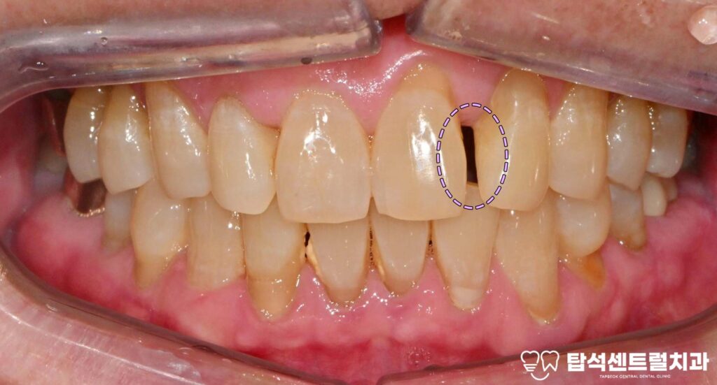 앞니 레진 앞니 벌어짐