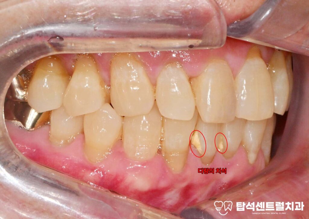 앞니 벌어짐 앞니 레진