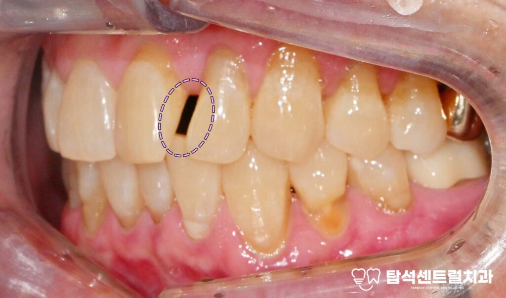 앞니 벌어짐 앞니 레진