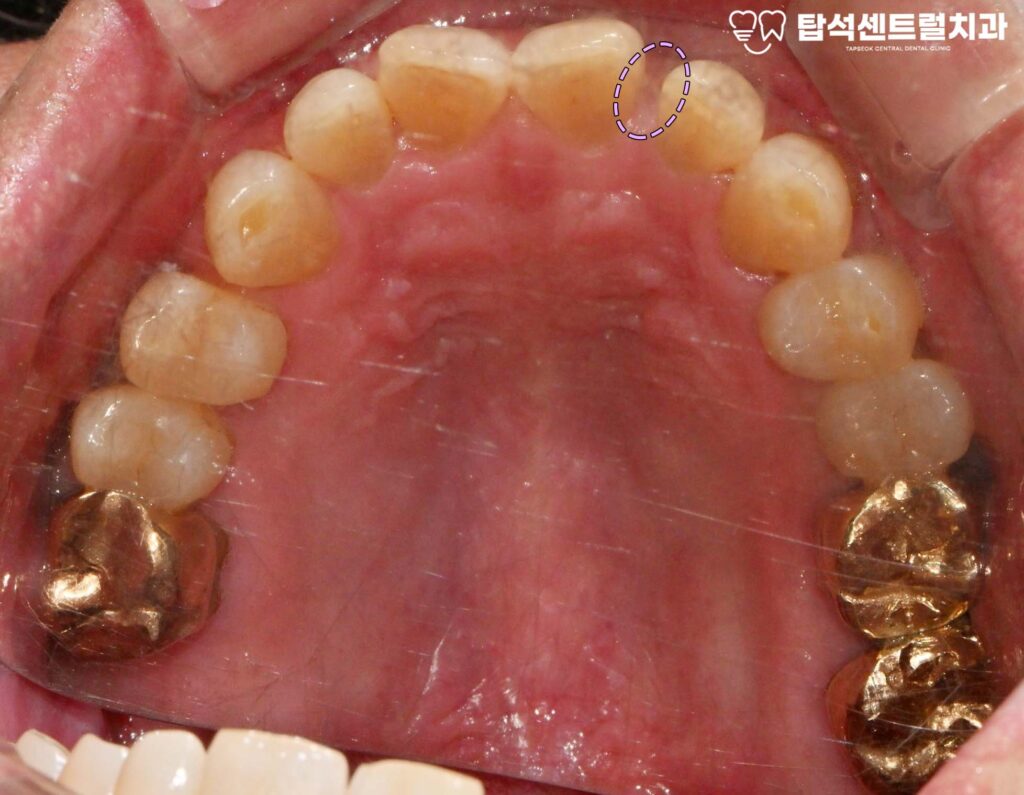 앞니 벌어짐 앞니 레진