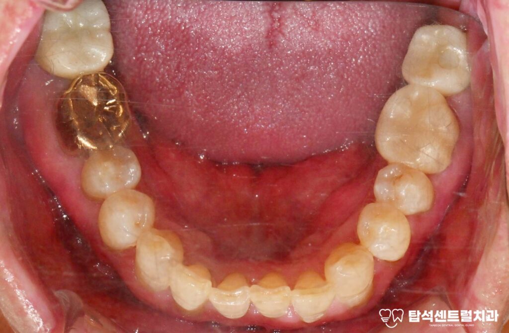 앞니 벌어짐 앞니 레진