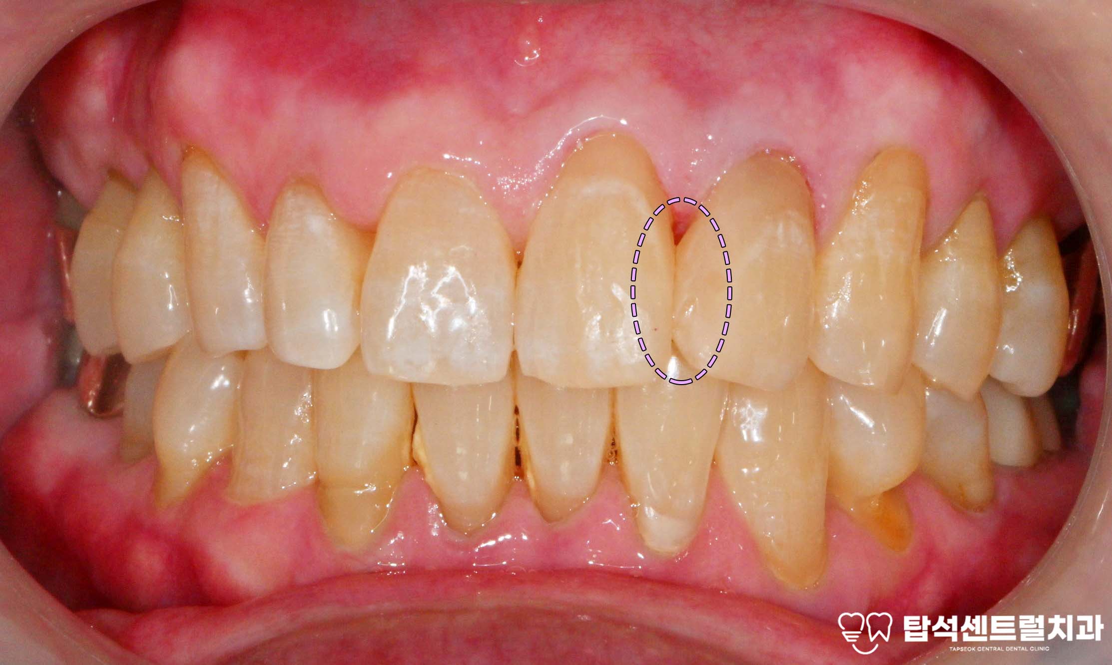 You are currently viewing 민락동 치과 벌어진 앞니 레진 치료 선택한 이유? 라미네이트, 크라운 2가지 방법과 다른 차이점,특징 궁금하다면