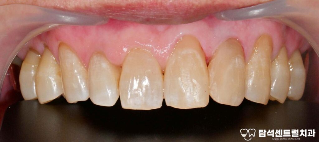 앞니 벌어짐 앞니 레진