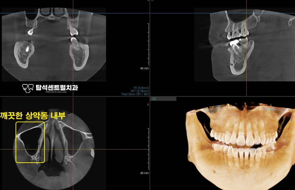 영상에서 염증이 소실된 것이 확인되고
 통증 역시 완전히 사라진 것을 알 수 있었습니다.

염증 치료 후 임플란트 진행

부비동에 염증이 남아 있는 상태에서
임플란트를 식립하기는 어렵습니다.

내부에 염증이 존재하면
식립한 임플란트가 주변 뼈 조직과
제대로 결합하지 못할 수 있습니다.

또한 염증이 주변으로 퍼지면서
추후 합병증이 발생할 위험도 있습니다.

따라서 충분한 시간을 두고
염증을 완전히 치료한 뒤에
식립 계획을 세우는 것이 바람직합니다.

이번 의정부 치과 에서 소개해드린
케이스의 경우에는, 아래턱에
임플란트를 식립할 예정입니다.