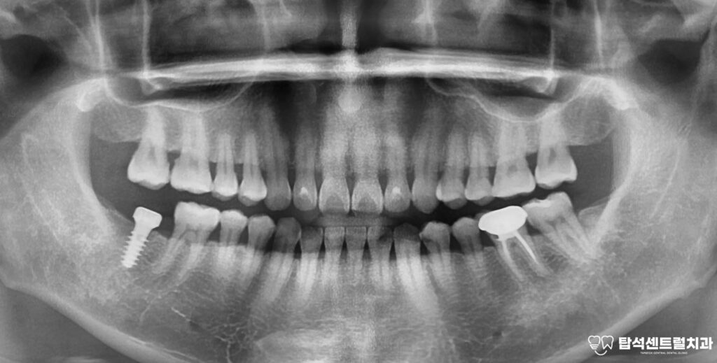 수술 후 일정 기간 동안
임플란트가 뼈와 단단히 결합하는
골유착 과정을 거치게 됩니다.

이 과정이 성공적으로 완료되면
보철물을 연결하여 마무리합니다.

잘 식립된 임플란트는
자연치아와 유사하게 기능하며
음식을 편안히 저작할 수 있게 됩니다.