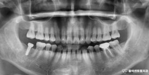 Read more about the article 의정부 치과 상악동염으로 인한 통증 발생의 이유? 임플란트 수술 case