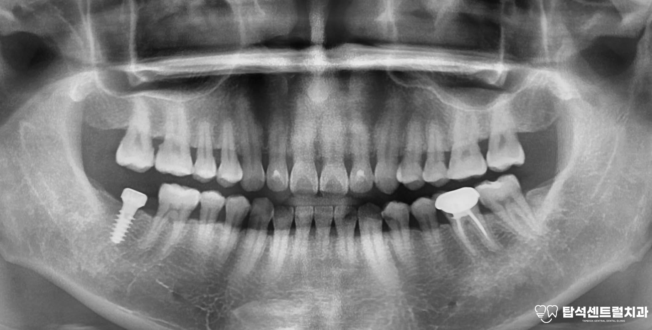 You are currently viewing 의정부 치과 상악동염으로 인한 통증 발생의 이유? 임플란트 수술 case