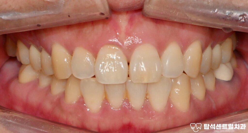 윗니 어금니 끝에서 통증이 느껴질 때
대부분 충치나 잇몸 질환을 의심합니다.

실제로 많은 경우, 치아 자체의 문제로
통증이 발생하는 것이 사실입니다.